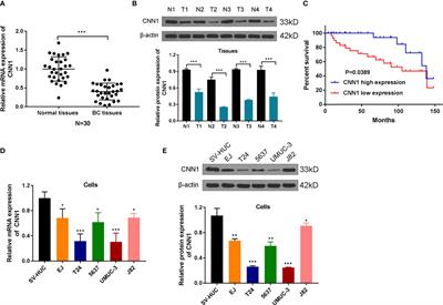 CNN1 Represses Bladder Cancer Progression and Metabolic Reprogramming by Modulating HIF-1α Signaling Pathway